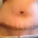 Scar treatment
