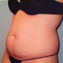 PS-Pre-Op pic