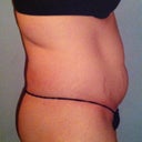 PS-Pre-Op pic Note lack of attachment if muscles right after ribs