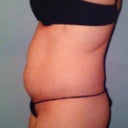 PS-Pre-Op pic