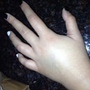 my hand after surgery...was gonna explode...it was nuts