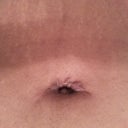 BB raised scar