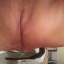 scar tx 2 weeks