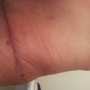scar tx 2 weeks