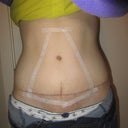 everything inside the taped off area is numb to the touch, and yes I mean EVERYTHING. you can still feel pressure on the muscles underneath but your skin will not feel any touch, scratch, etc for a while.