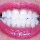 After Invisalign.  Distance photo looks fabulous. My teeth were nearly how I expected, but several refinements didn't move bottom R  teeth.