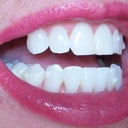 Left side: After Invisalign teeth were still slanted outward, not down like I wanted them. L needs a lot of refinement.