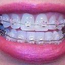 So here is my first day photo of getting Clear Ceramic Braces on my teeth.