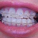 Different view of first day of Clear Ceramic Braces.  Front upper teeth still sit on neighboring teeth.