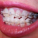 Right side: First day right lower teeth are still misaligned.