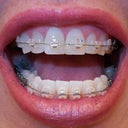 My old dentist shaved my front teeth uneven to move them.  I wish he hadn't done this.  First day top and bottom teeth still slightly crowded.