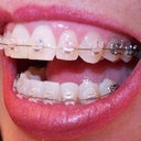 Right side: First day, for some people this would be fine the teeth are nearly straight but need lower R refinement.  Lower teeth have to be pulled in for top ones to slant down.