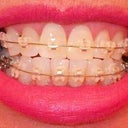 First day I think the teeth need to be pull to the left and to the right and down.