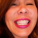 Smiling like an Opossum with my first Ceramic Braces done in my late 40's.