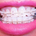 15 days after Ceramic Braces.