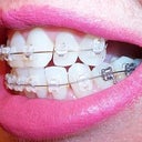 Left side. Day 15 teeth are getting loose spaces.  Moving in undesirable positions. L side needs a lot of work.