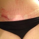 Post Op Day 33 - incision opening on right groin area