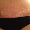 Post Op Day 33 - closer view of right groin area incision opening