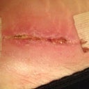 Post Op Day 33 - even closer view of right groin area ncision opening!