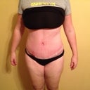 Post Op Day 33 - front view