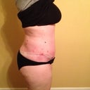 Post Op Day 33 - right side