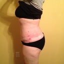 Post Op Day 33 - left side