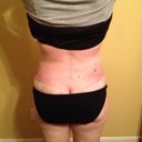 Post Op Day 33 - back