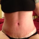Post Op Day 33 - front view - sitting - loving the line definition down the middle of my tummy!