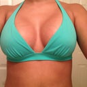 1 month post op! can't wait until swimsuit season.