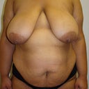 Before breast reduction/lift and Tummy Tuck
