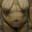 Right before the surgery -- the mark-up