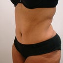 After surgery -- 6 months