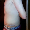 3.5 Weeks Post Op Side View - Swelling starting to subside.