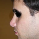 6 months after surgery