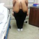 This is me the days of surgery without my bra... 42JJ