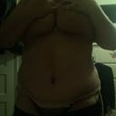 13 days post op naked