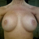 Four months post-op. Went from a 34A to 34D.