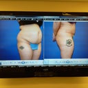 before and after