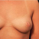 Nipple Surgery