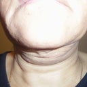 my neck fell when the scare tissue was not done right