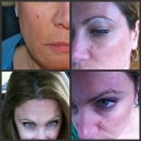 before peels