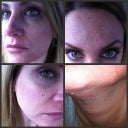 during peels