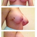 Day 13 Post Op