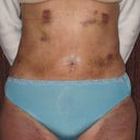 Post-op day 3, great result already