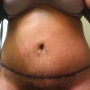 one week post op.