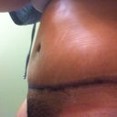 one week post op