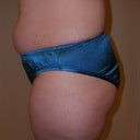 Ugh - Muffin top - Day before surgery