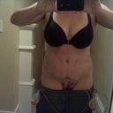 5 days post op front view. I am very swollen and bruised.