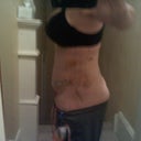 5 days post op without garment. I am so swollen still. I don't see much of a difference.