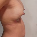 Side shot right breast at 2 days post-op.